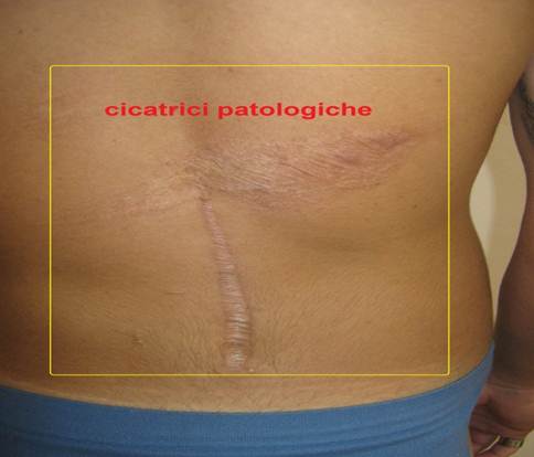cicatrice patologica1